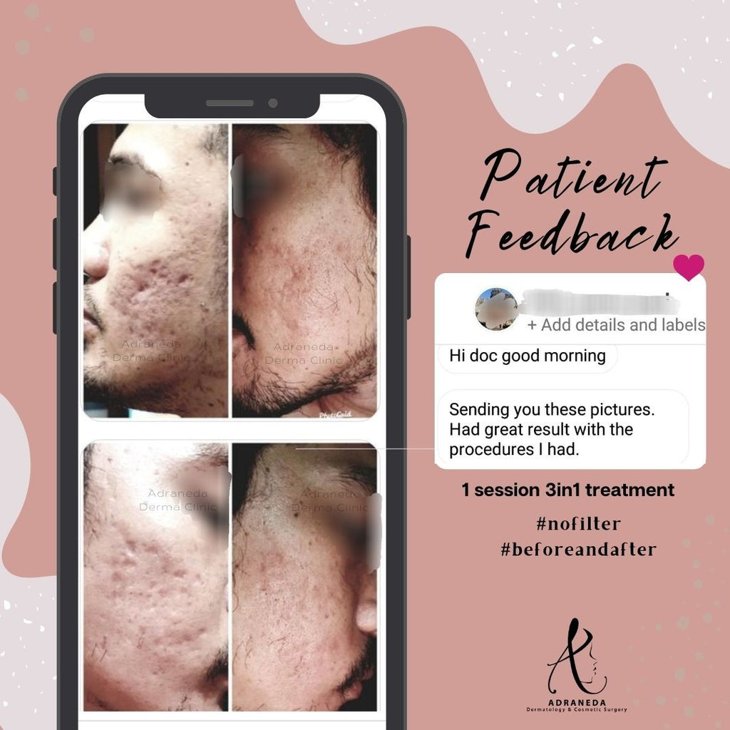 Got ACNE SCARS? Trust only...