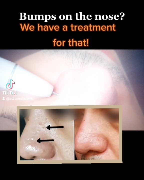 Bumps on the nose? Have...