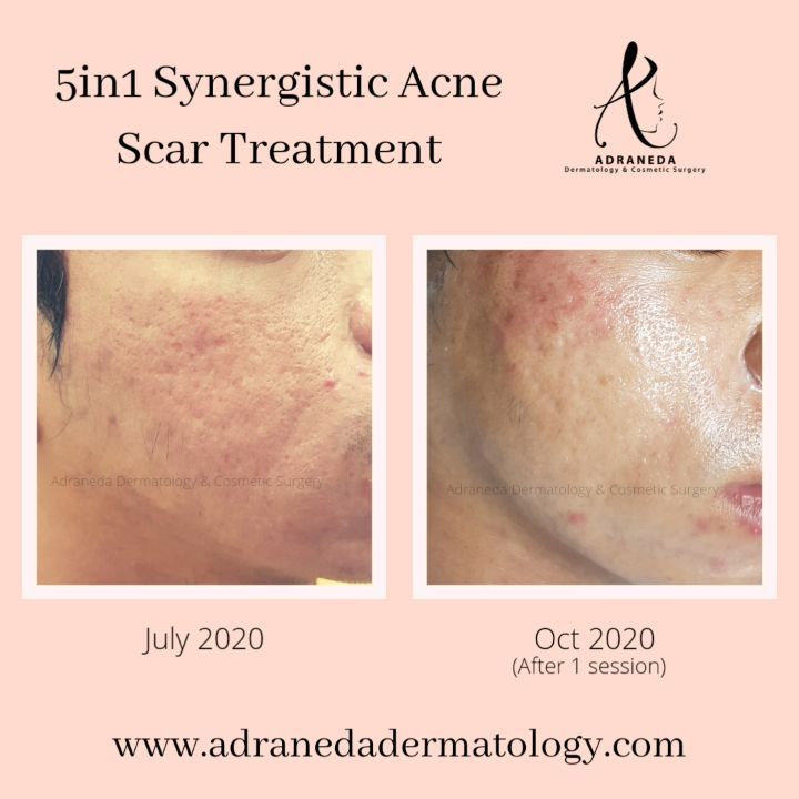 Do you want to impro