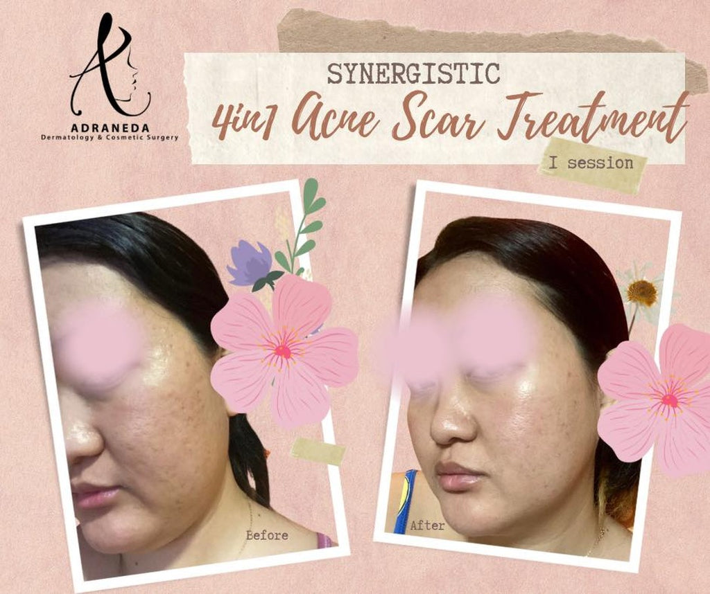 With our 4in1 Synerg