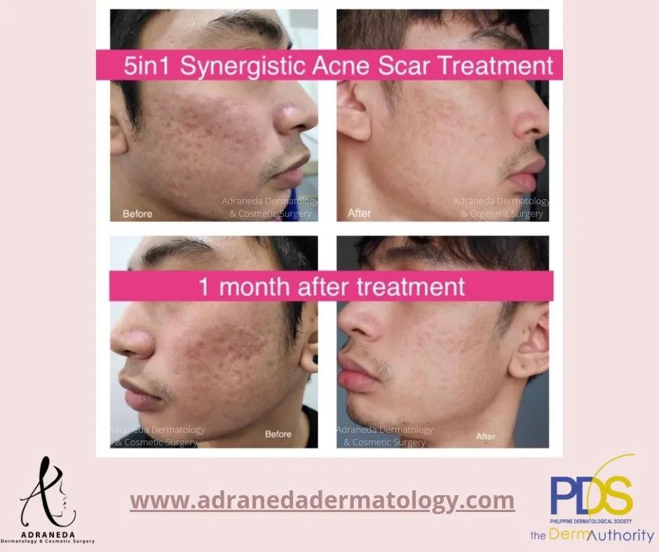 5in1 Synergistic Acn