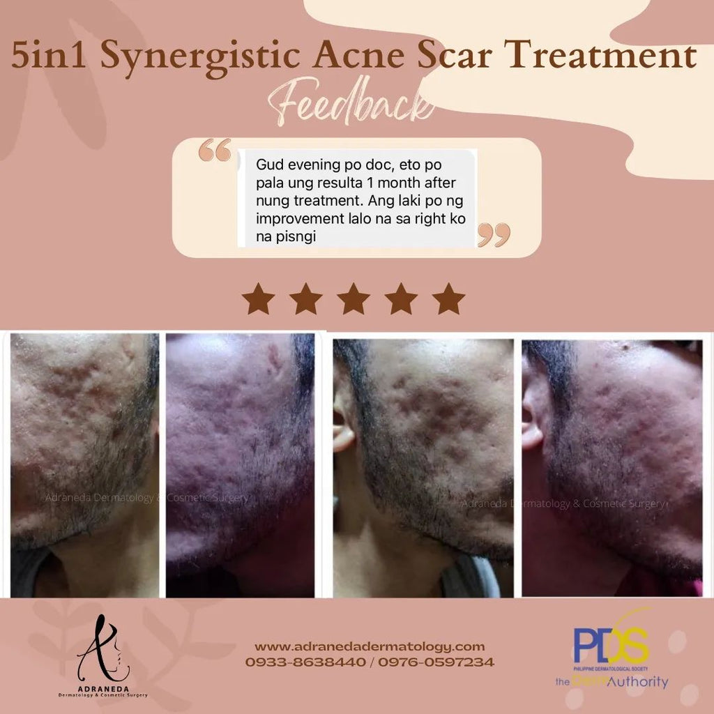 5in1 Synergistic Acn