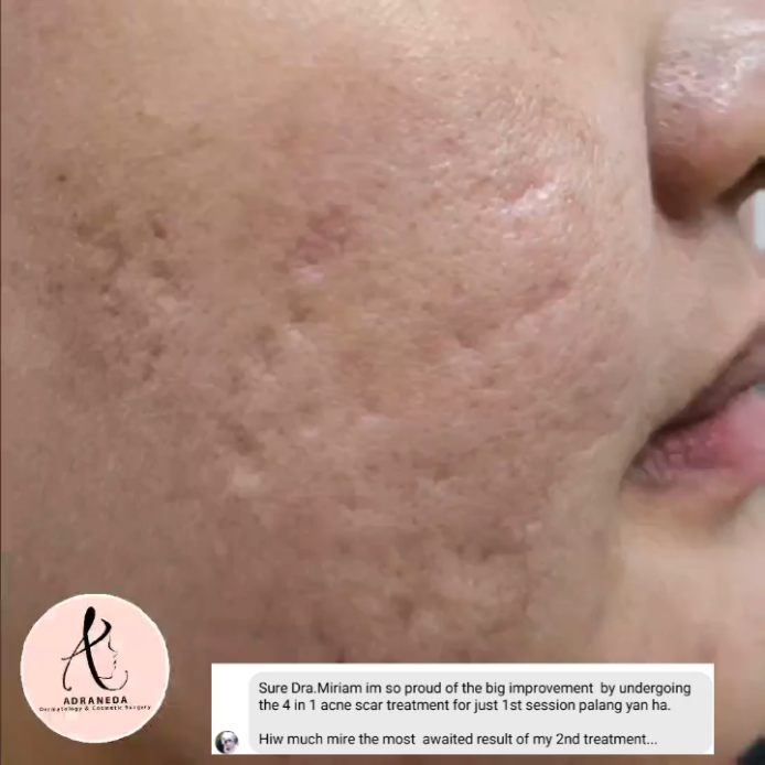 After 1 session of o