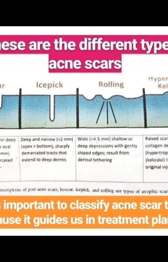 What is the best tre