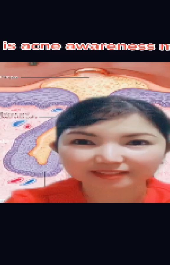 June is Acne Awarene