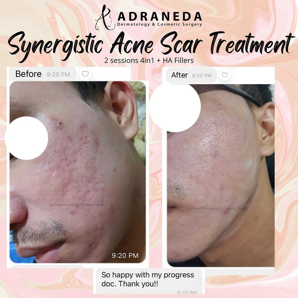 Fillers can do wonde