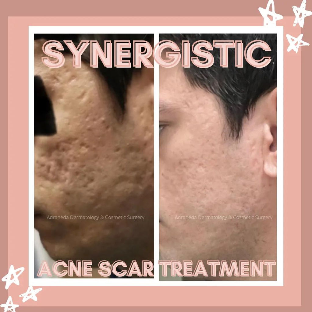 After 1 session of 5