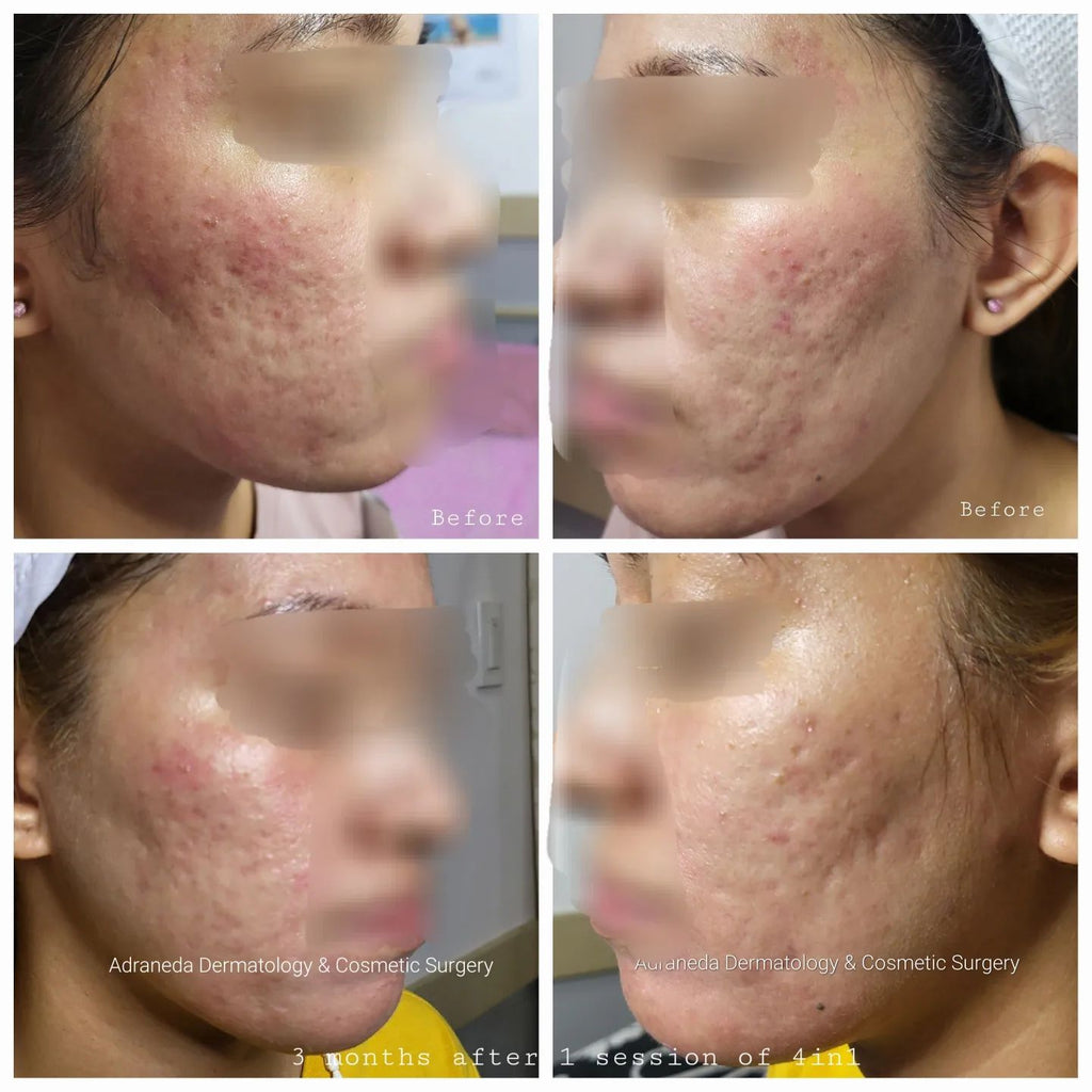 3 months after 1 ses