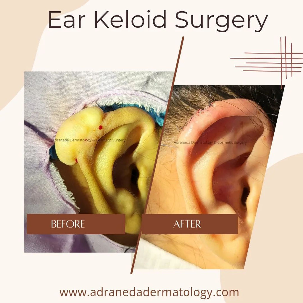 Ear Keloid Surgery
