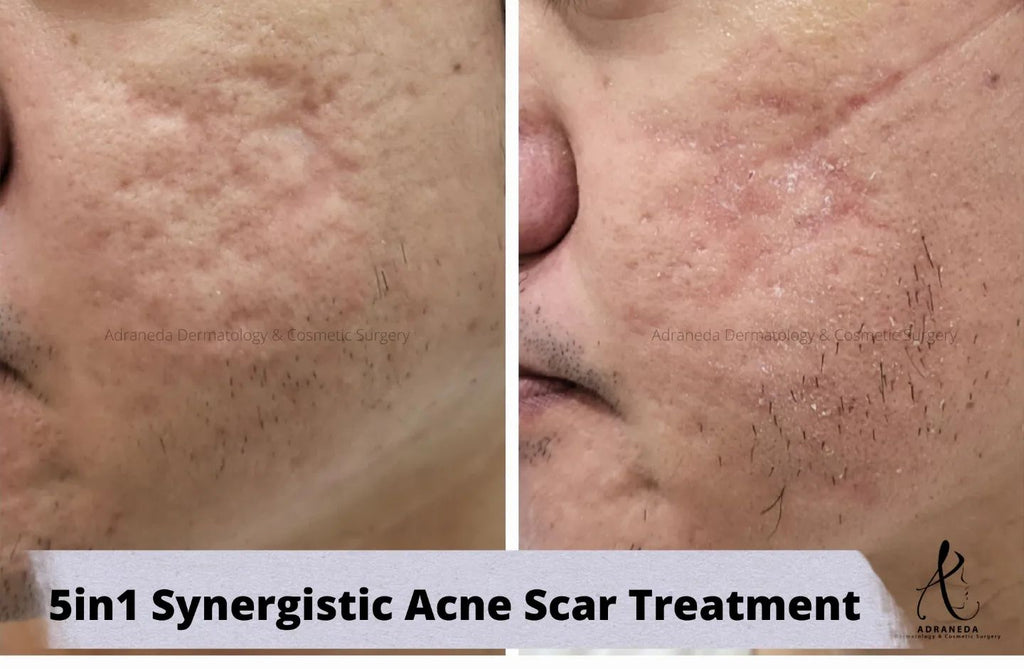 3 months after 1 ses