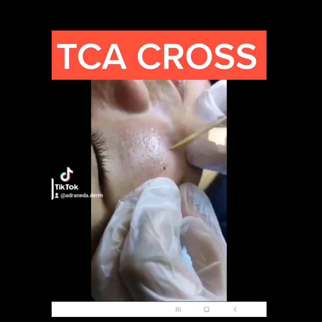 TCA CROSS treatment