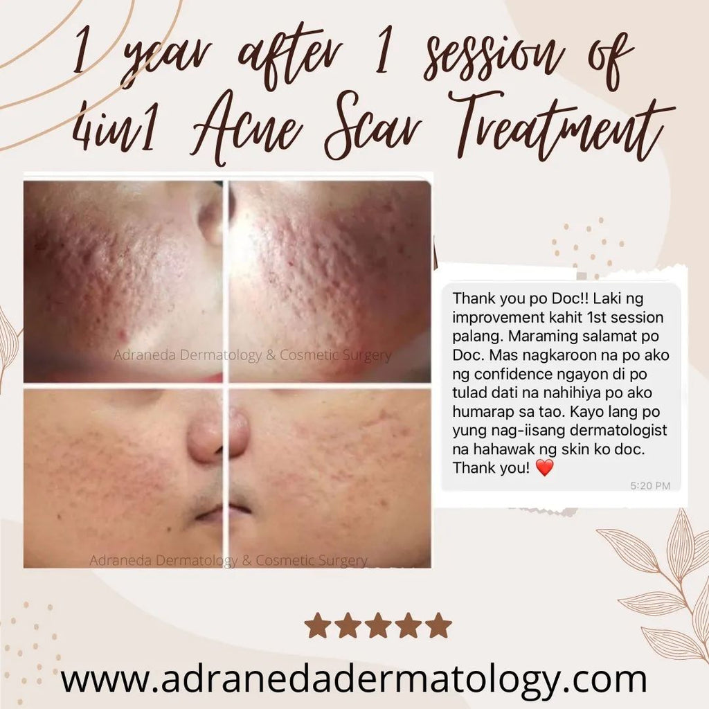 1 year after 1 sessi