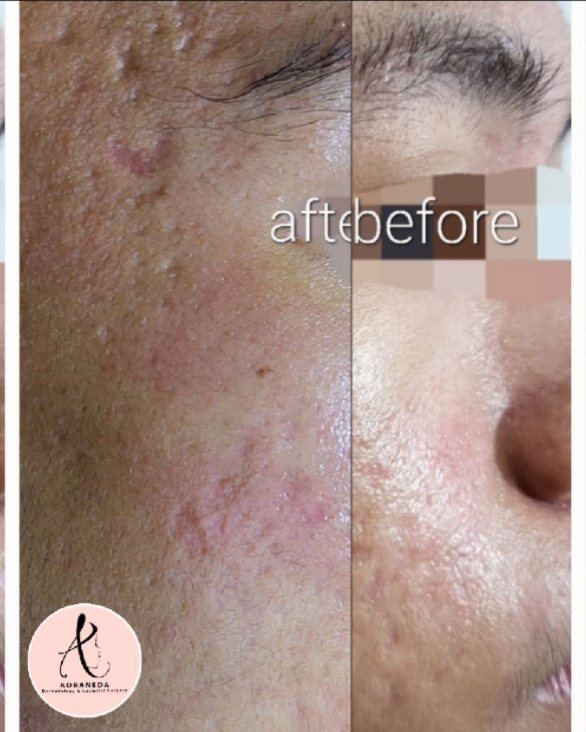 Beforr and After 2 s