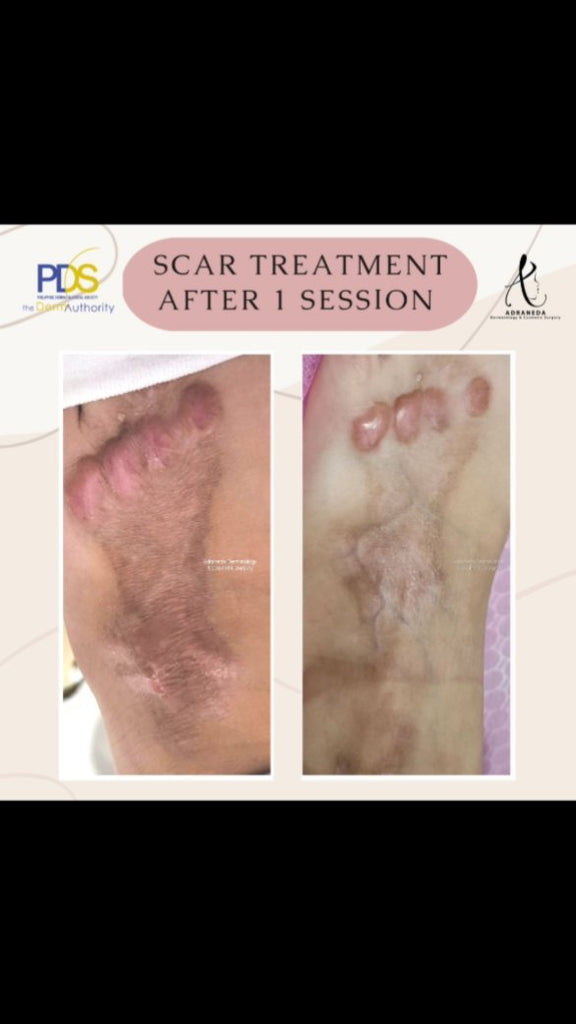 Let's help you erase