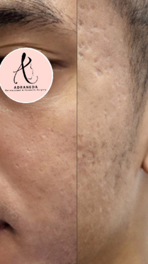 After 1 session of 4