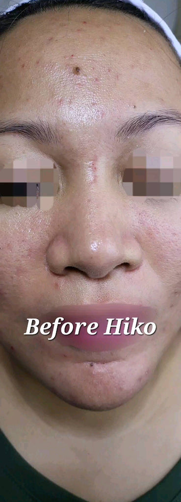 Hiko Nose Threadlift