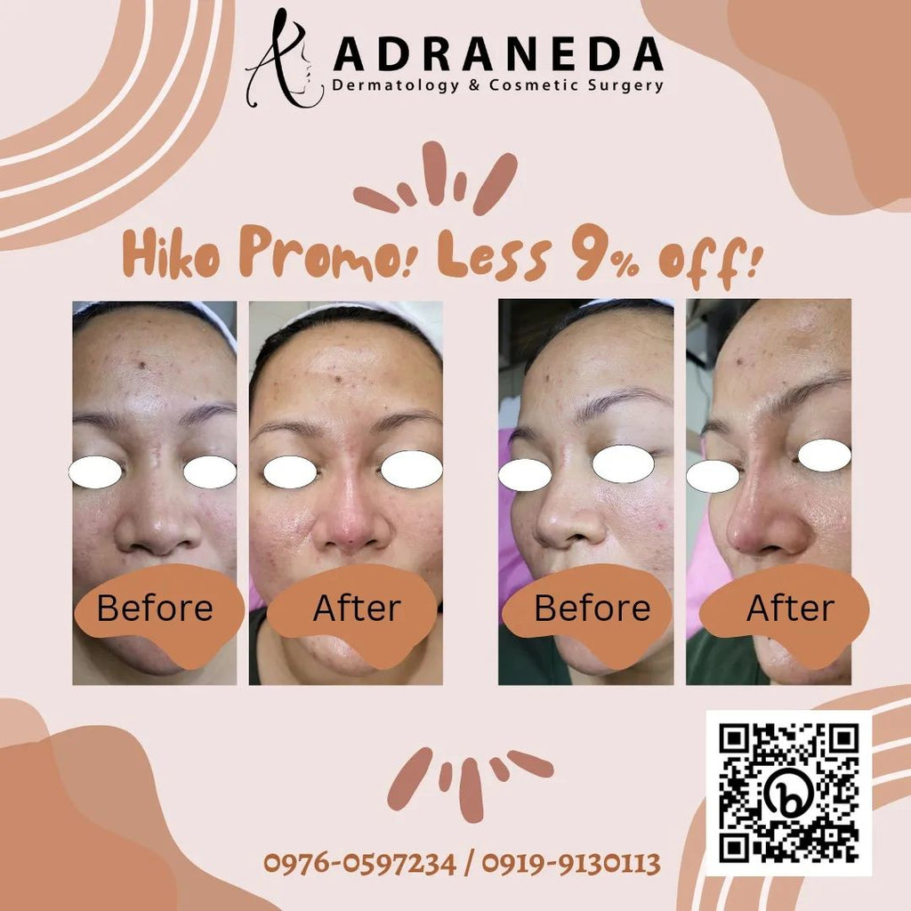 Hiko nose threadlift