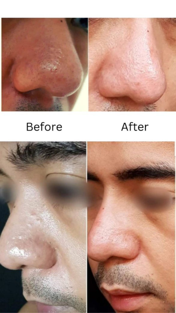 RFMA or RF Microneed