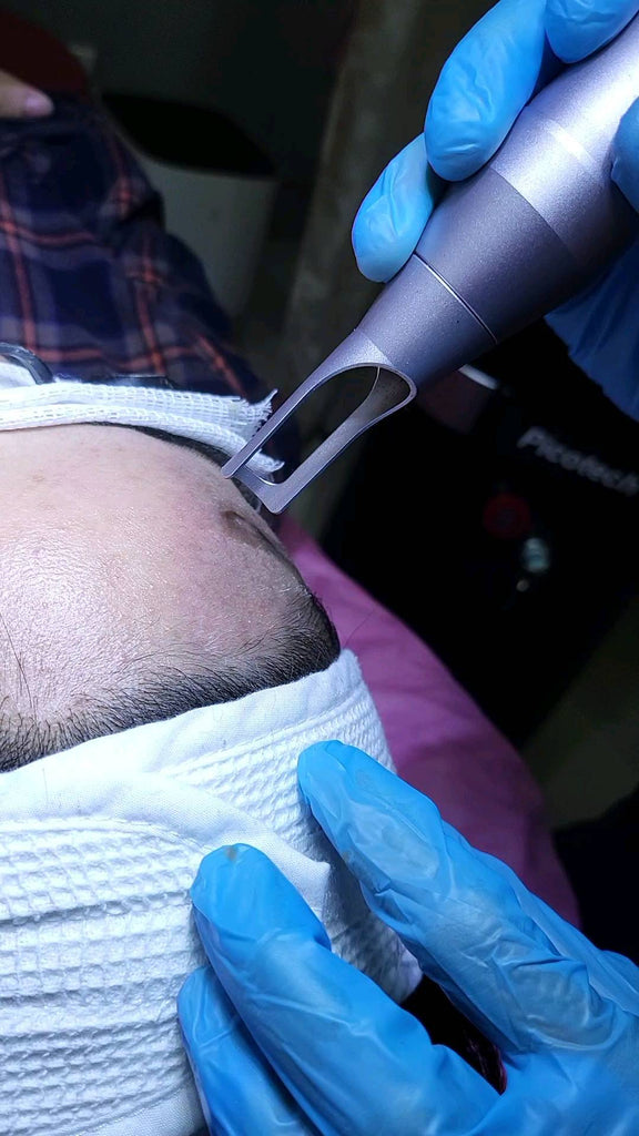 Pico laser helps tre