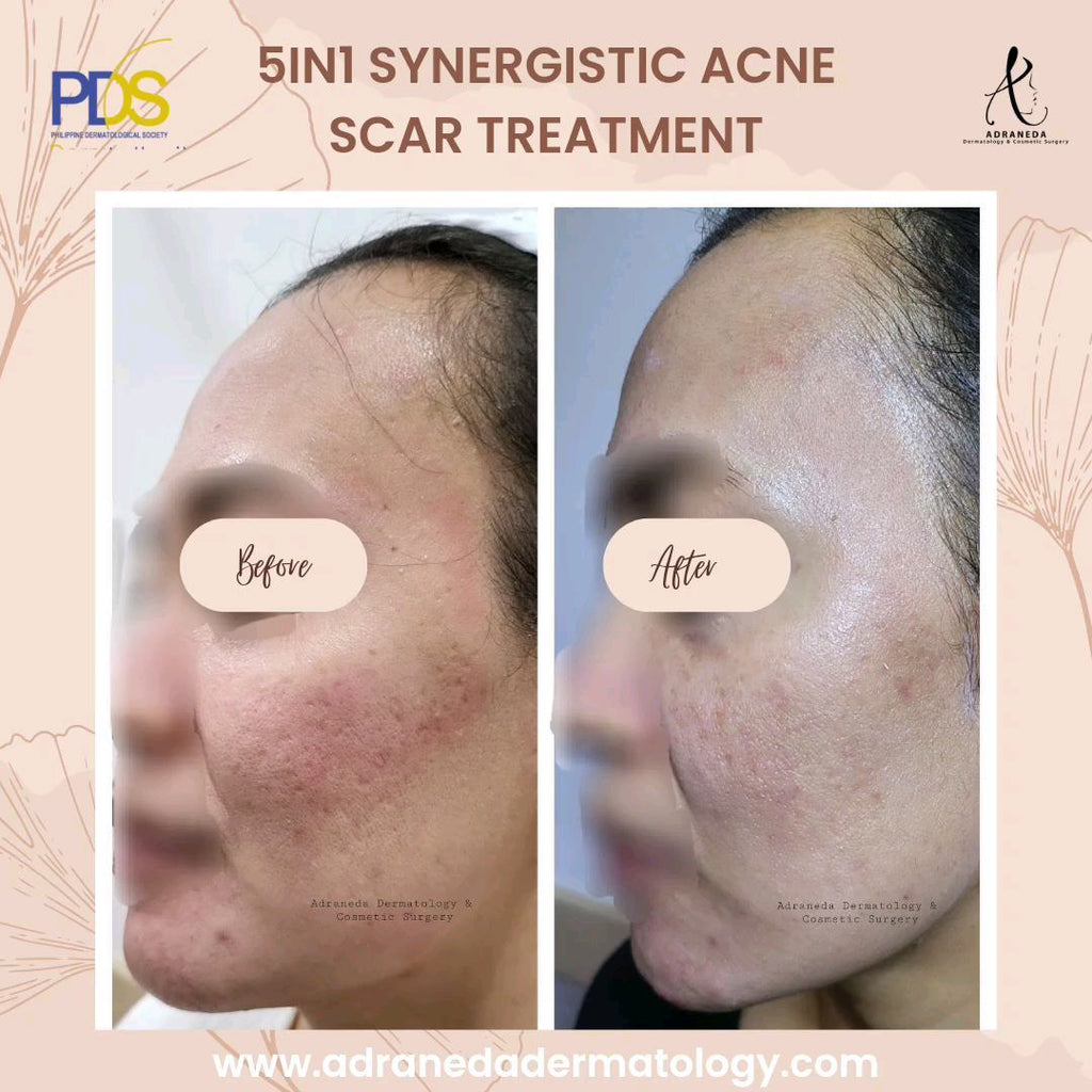 1 month after 5in1 S