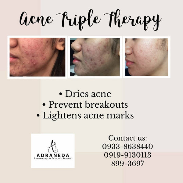 Acne Treatments - Adraneda Dermatology & Cosmetic Surgery Clinic