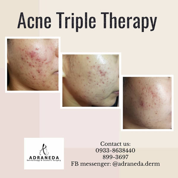 Acne Treatments - Adraneda Dermatology & Cosmetic Surgery Clinic