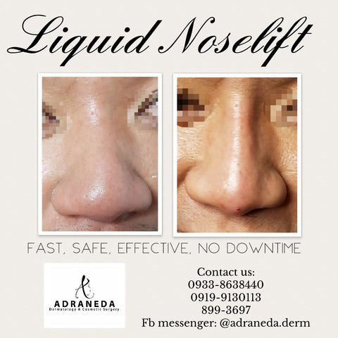 Non-surgical noselift - Adraneda Dermatology & Cosmetic Surgery Clinic
