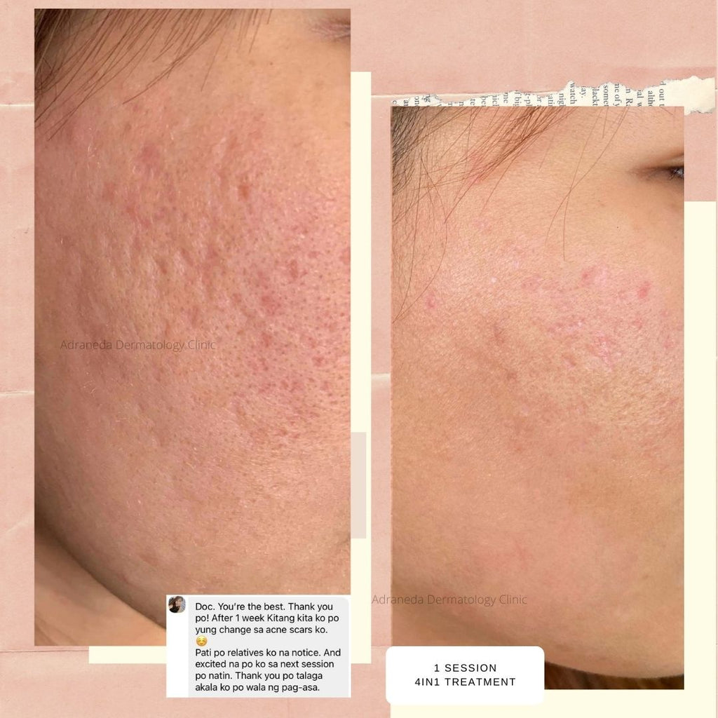 Synergistic Acne Scar Treatment - Adraneda Dermatology & Cosmetic Surgery Clinic