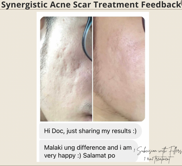 Synergistic Acne Scar Treatment - Adraneda Dermatology & Cosmetic Surgery Clinic