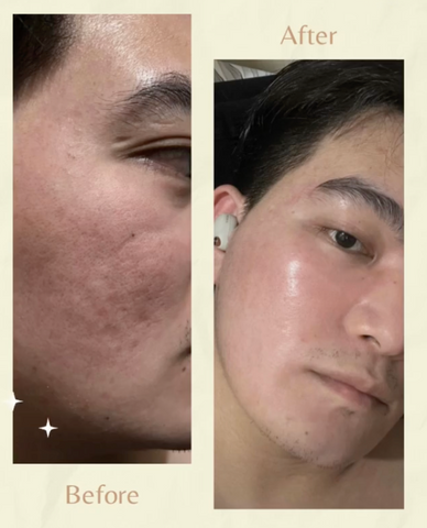 5in1 Synergistic Acne Scar Treatment