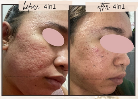 4in1 Synergistic Acne Scar Treatment