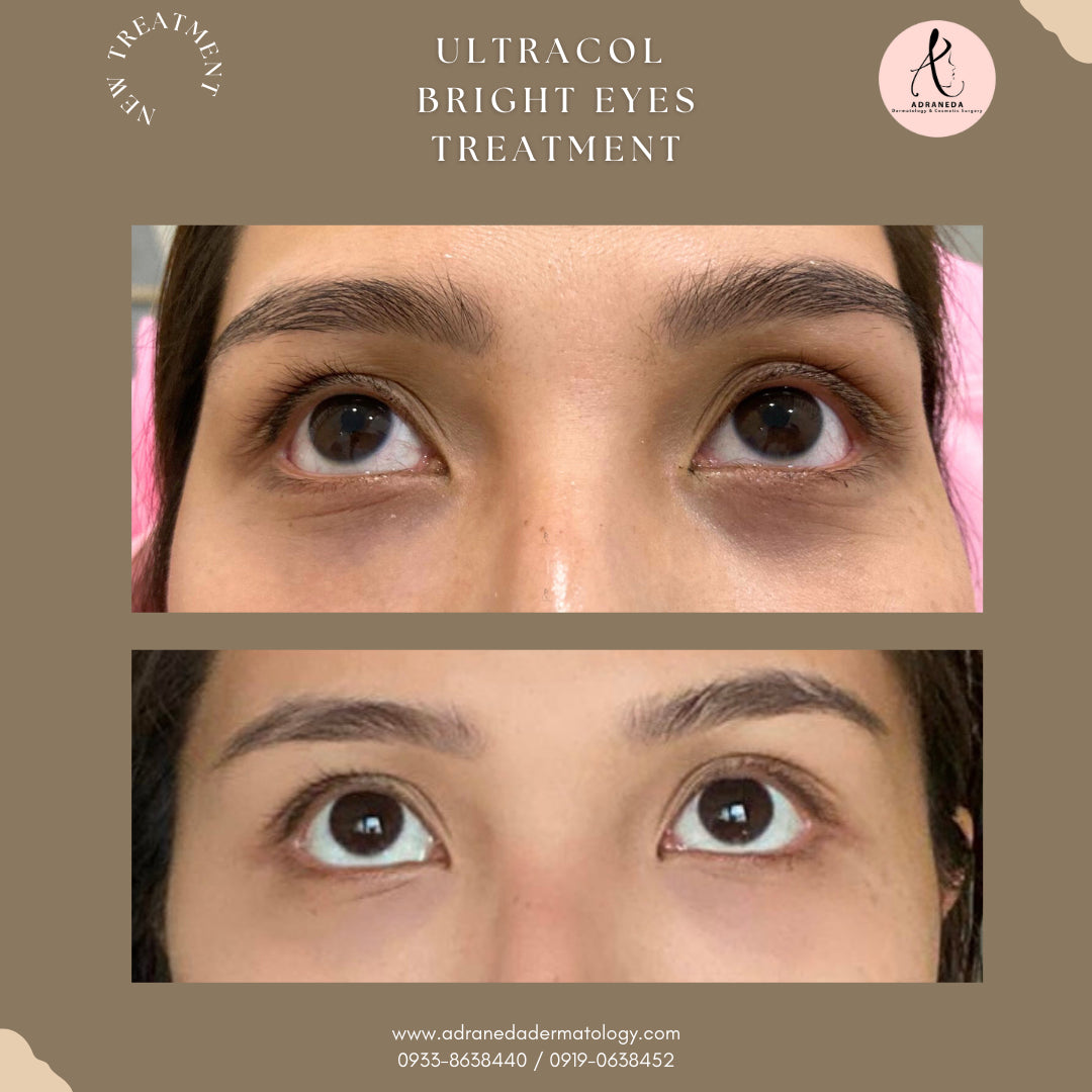 Ultracol Eyebags Treatment