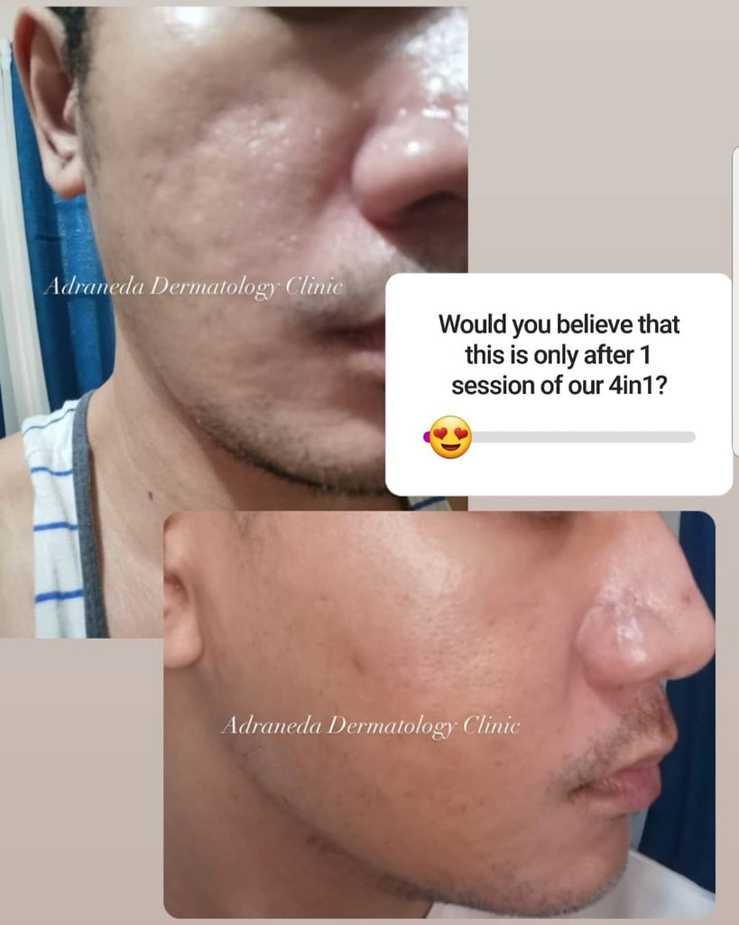 Acne scar improvement after 1...