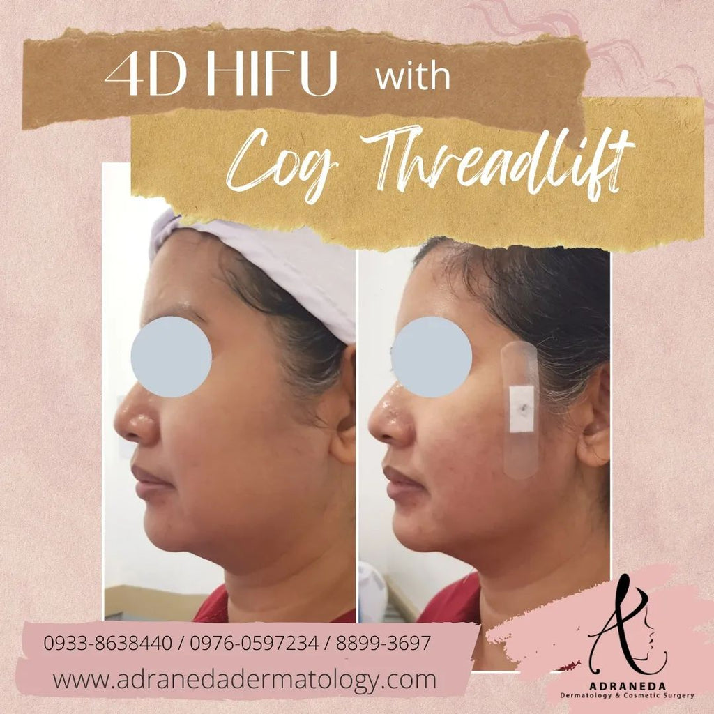 4D HIFU with COG Thr