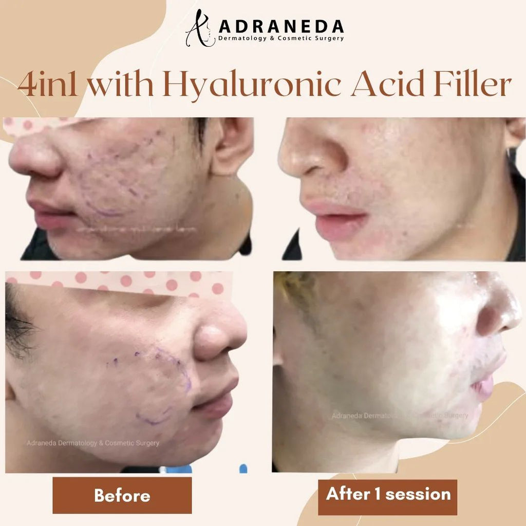 For patients with ro