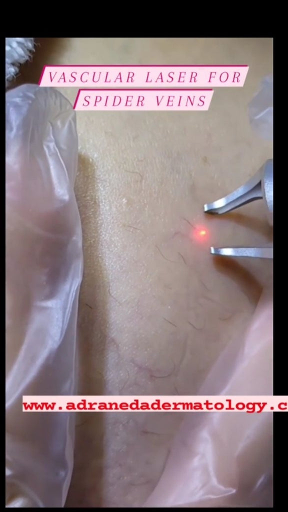 Vascular Laser for S