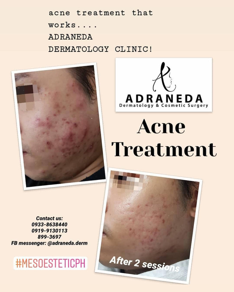 Acne Treatments - Adraneda Dermatology & Cosmetic Surgery Clinic