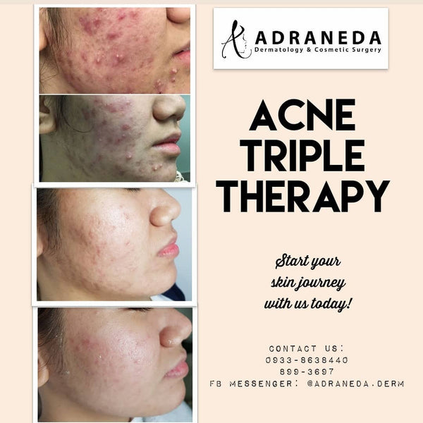 Acne Treatments - Adraneda Dermatology & Cosmetic Surgery Clinic