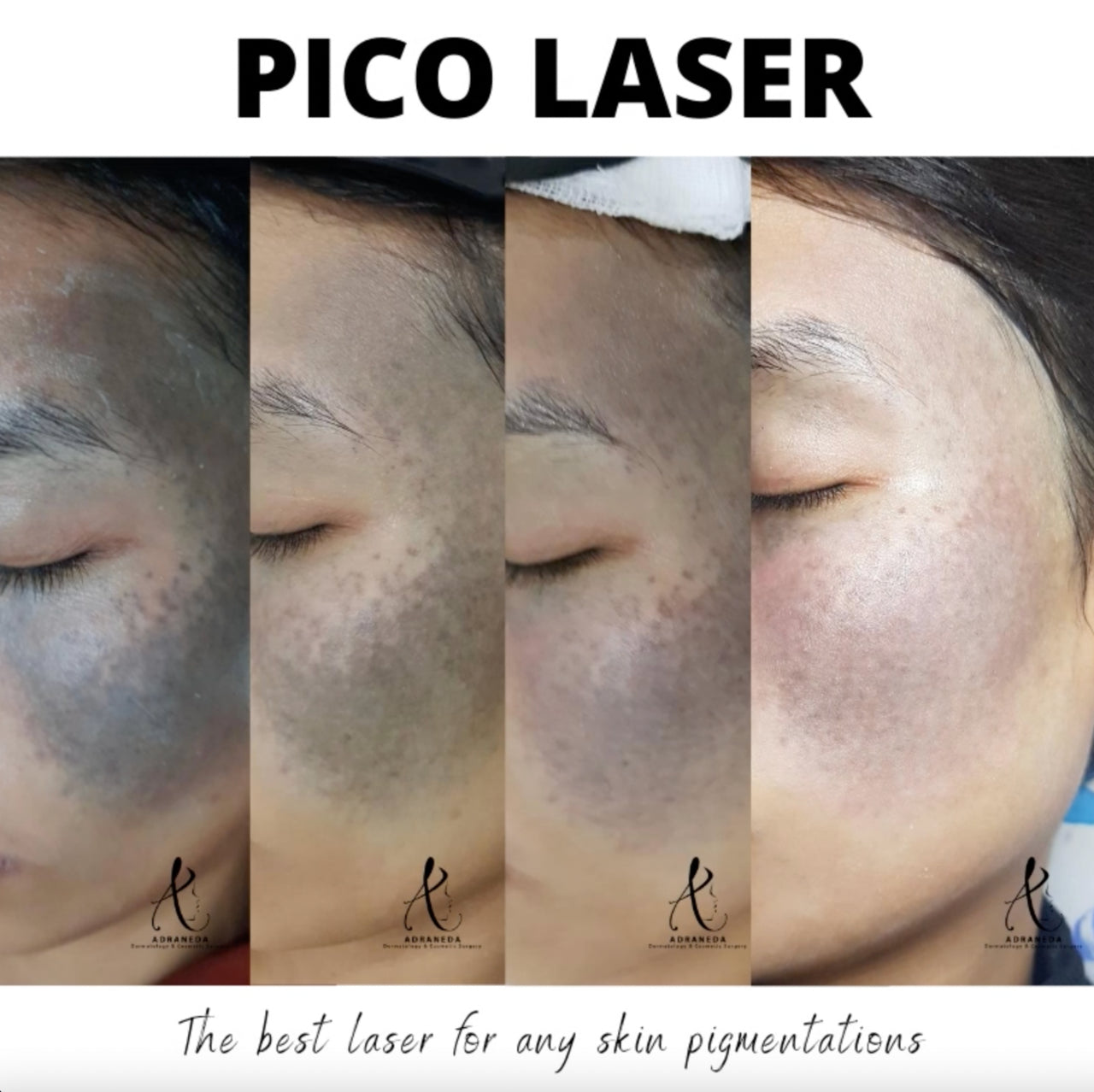 Pico laser, qs ndyag laser, freckles, melasma treatment, tattoo removal, birthmark removal, mole removal, acne marks, leg scars treatment